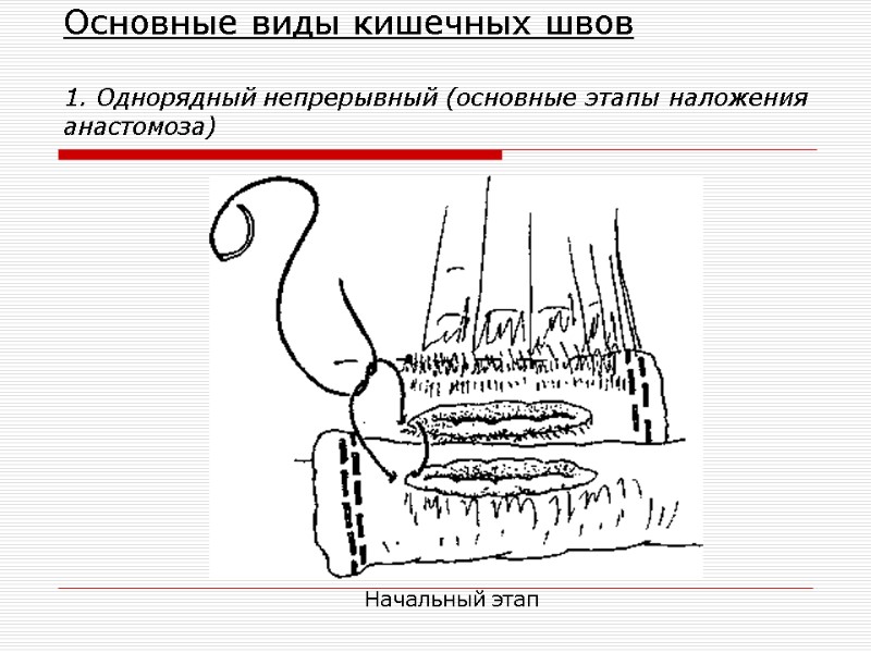 Основные виды кишечных швов  1. Однорядный непрерывный (основные этапы наложения анастомоза) Начальный этап